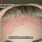 Yüz Egzaması Belirtileri Nelerdir?