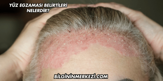 Yüz Egzaması Belirtileri Nelerdir?