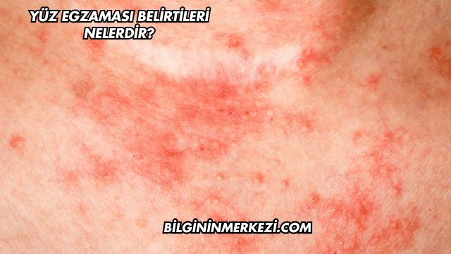 Yüz Egzaması Belirtileri Nelerdir?