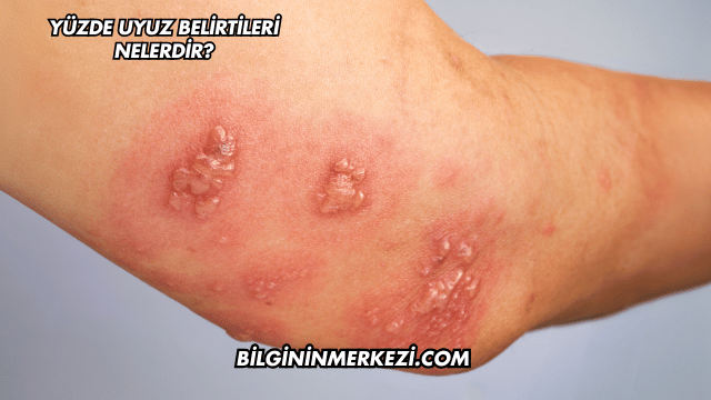 Yüzde Uyuz Belirtileri Nelerdir?