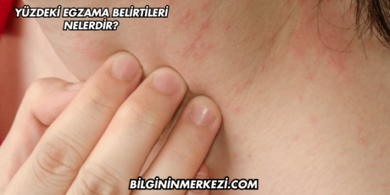 Yüzdeki Egzama Belirtileri Nelerdir?