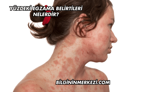 Yüzdeki Egzama Belirtileri Nelerdir?